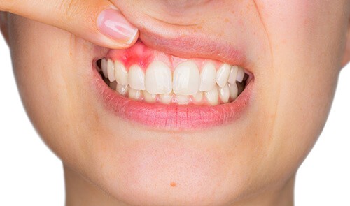 Choose Tried-and-True Methods to Treat Gum Disease